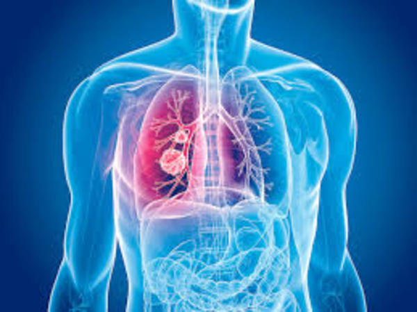 El cáncer de pulmón afecta de manera silenciosa » Ñanduti