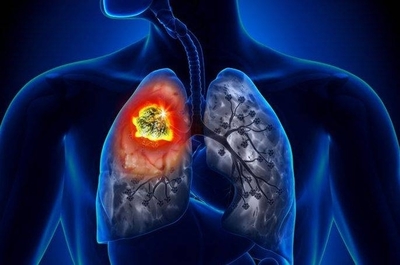 HOY / El cáncer de pulmón: sin síntomas en primera fase dificulta la detección temprana