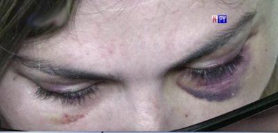 Mujer denuncia brutal agresión por parte de su pareja | Noticias Paraguay