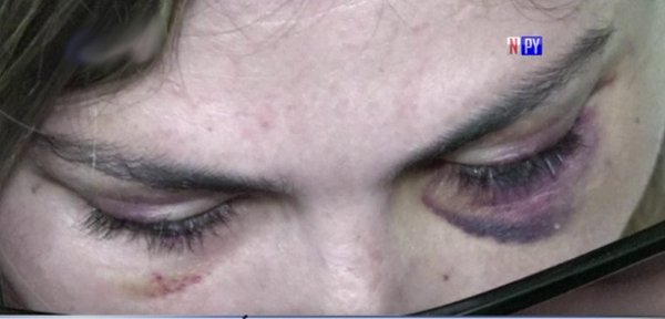 Mujer denuncia brutal agresión por parte de su pareja | Noticias Paraguay