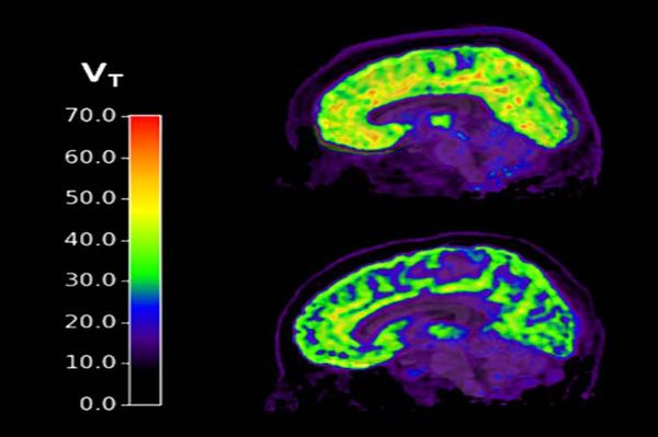 Un biomarcador cerebral predice el consumo compulsivo de alcohol  - Tecnología - ABC Color