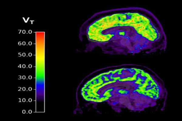 Un biomarcador cerebral predice el consumo compulsivo de alcohol - Tecnología - ABC Color