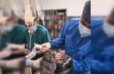 El impactante video de los pulmones de un donante que llevaba fumando 30 años: fueron rechazados - SNT