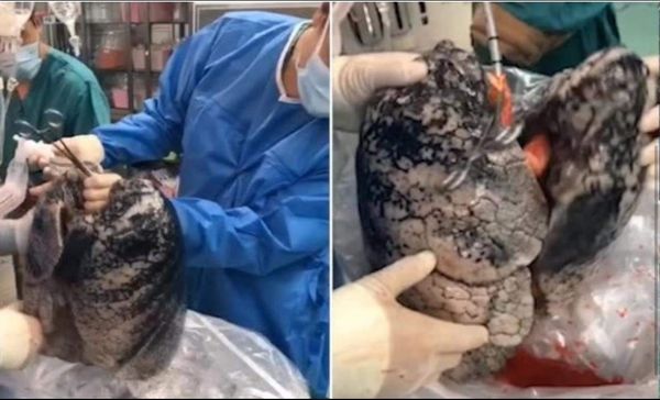 Así quedaron los pulmones de un hombre que fumó durante 30 años y murió - Digital Misiones
