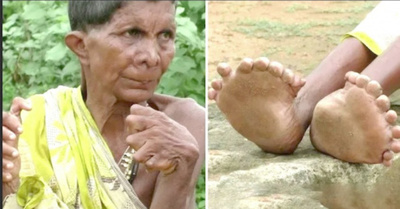 Tiene 20 dedos en los pies y 12 en las manos