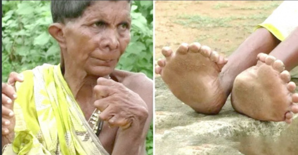 Tiene 20 dedos en los pies y 12 en las manos