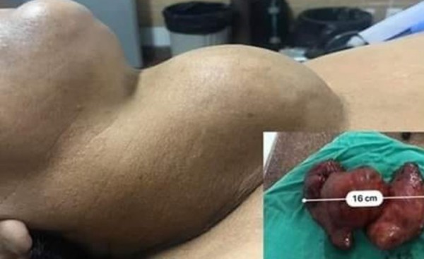 Exitosa extirpación de un bocio de 1kg en el Hospital Regional