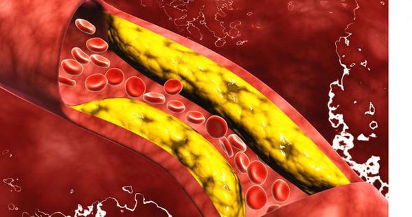 Colesterol: Bajar de manera precoz disminuye riesgos cardiovasculares