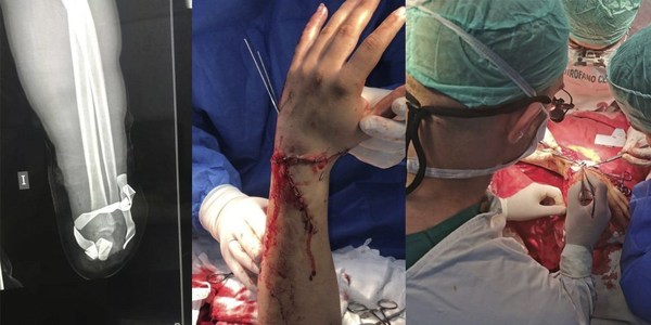 TRAUMATÓLOGOS DEL IPS REALIZAN PRIMER IMPLANTE TOTAL DE MANO TRAS AMPUTACIÓN TRAUMÁTICA