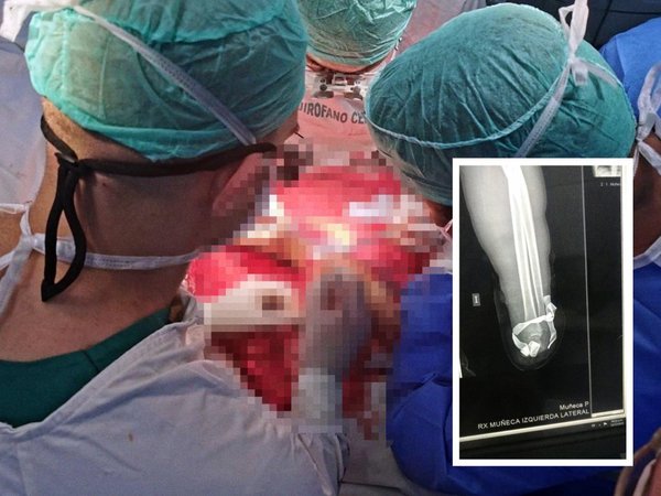 Médicos de IPS reimplantan por primera vez una mano amputada