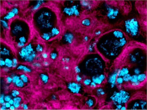 Descubren mecanismo celular implicado en el tumor cerebral más agresivo