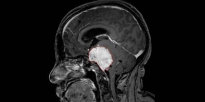 Descubren un mecanismo celular implicado en el tumor cerebral más agresivo - Ciencia - ABC Color