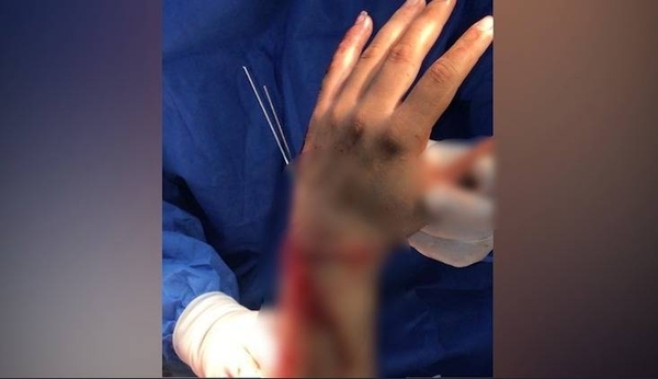HOY / Sufrió accidente laboral y perdió la mano, en IPS se la implantaron con cirugía reconstructiva