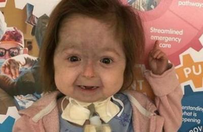 El caso de la niña de dos años con la 'enfermedad de Benjamin Button' - SNT