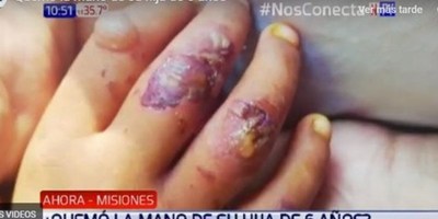 MUJER CASTIGÓ A SU HIJA QUEMÁNDOLE LA MANO