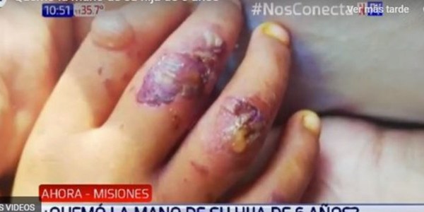MUJER CASTIGÓ A SU HIJA QUEMÁNDOLE LA MANO