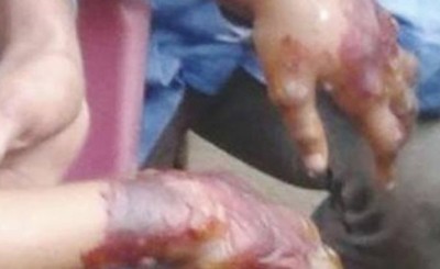 Metió la mano de su hija en un fogón por usar G. 5.000