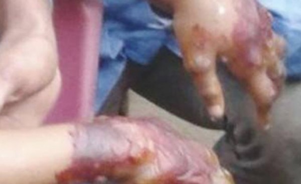 Metió la mano de su hija en un fogón por usar G. 5.000