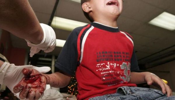 Pirotecnia: niños sin dedos, ciegos y en terapia
