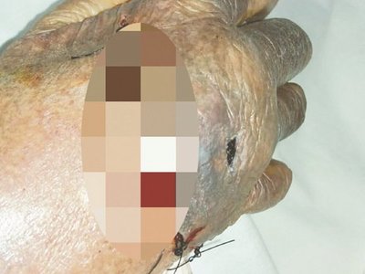 Abuela entró a cirugía y le tajearon la mano: hoy falleció