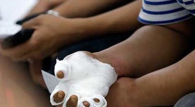 NIÑO DE 2 AÑOS PISÓ CEBOLLÓN Y LE AMPUTARON DEDO DEL PIE, UN ADULTO PERDIÓ TRES DEDOS