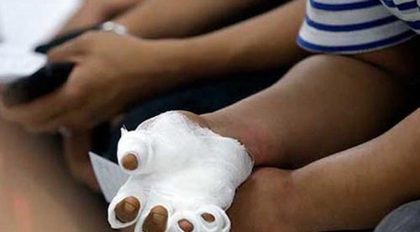 NIÑO DE 2 AÑOS PISÓ CEBOLLÓN Y LE AMPUTARON DEDO DEL PIE, UN ADULTO PERDIÓ TRES DEDOS