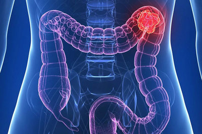 Aumentan casos de cáncer de colon en pacientes jóvenes