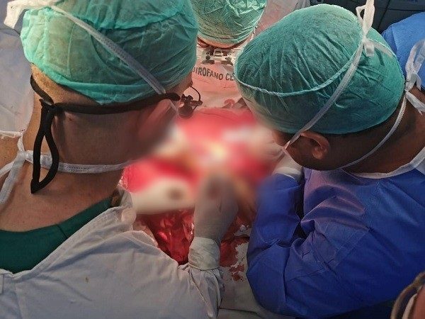 Exitoso primer implante de mano a paciente amputado en IPS
