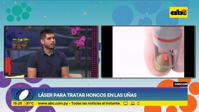 Láser para tratar hongos en las uñas - Ensiestados - ABC Color