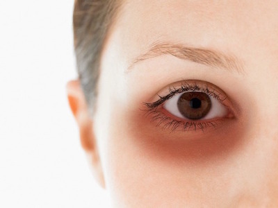 ¿Cómo combatir las ojeras, con remedios naturales?