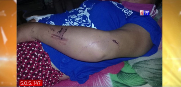 Denuncia que fue agredida brutalmente por su pareja | Noticias Paraguay