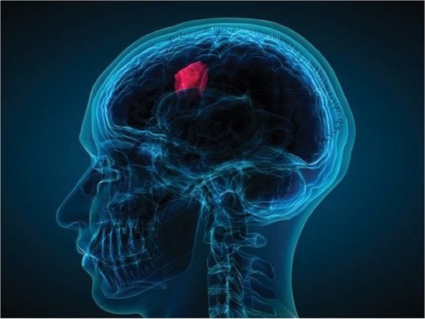 La ciencia abre nueva vía contra tumores cerebrales más agresivos