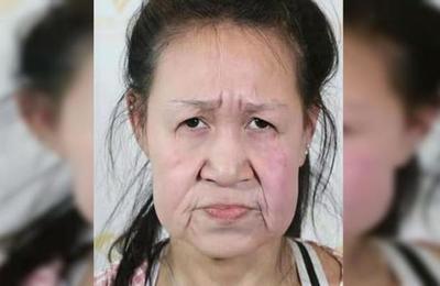 Niña de 15 años tenía rostro de anciana, se sometió a una cirugía y ahora luce irreconocible - SNT