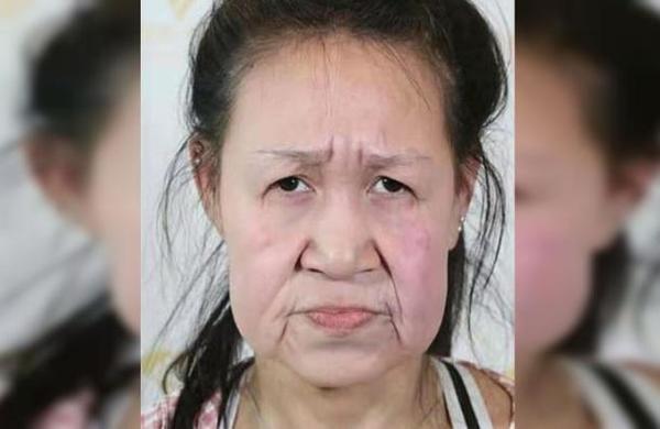 Niña de 15 años tenía rostro de anciana, se sometió a una cirugía y ahora luce irreconocible - SNT