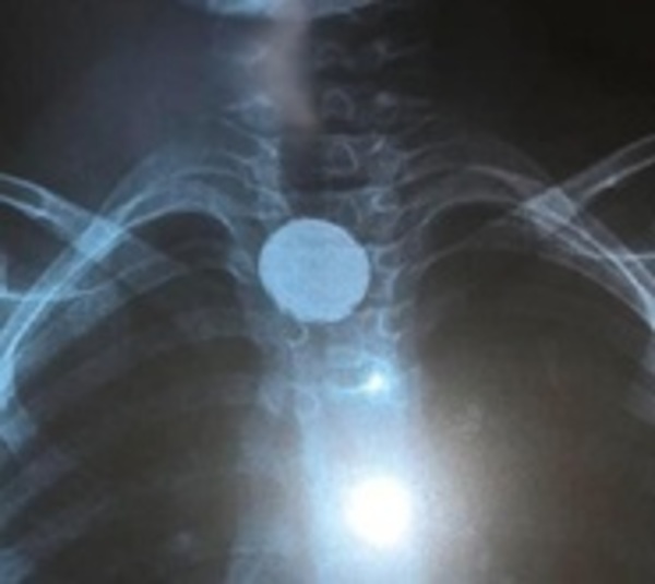 Derivan a niño a terapia intensiva tras tragar pila - Paraguay.com