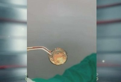 Niño de 6 años que ingirió una pila evoluciona favorablemente tras cirugía » Ñanduti