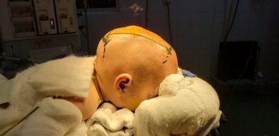 IPS realiza con éxito a un bebé la primera craneosinostosis del país