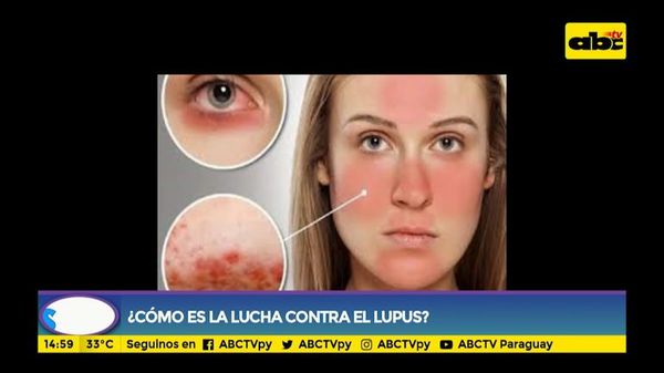 ¿Cómo es la lucha contra el lupus? - Ensiestados - ABC Color
