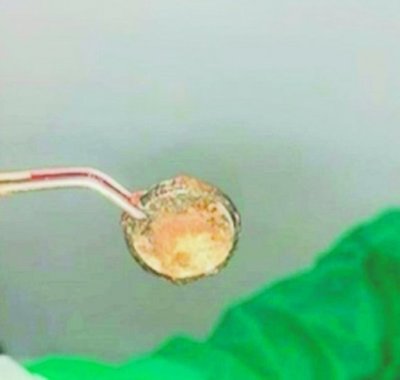 Nene tragó una pila y quedó en terapia intensiva