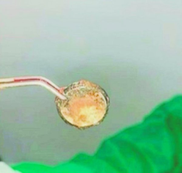 Nene tragó una pila y quedó en terapia intensiva