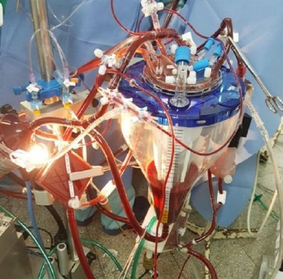 Aplican innovadora técnica en una cirugía cardiaca compleja | Info Caacupe