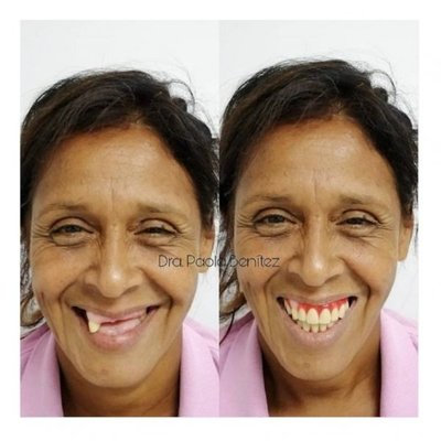 "Mi novio está feliz, ya tengo mis dientes"