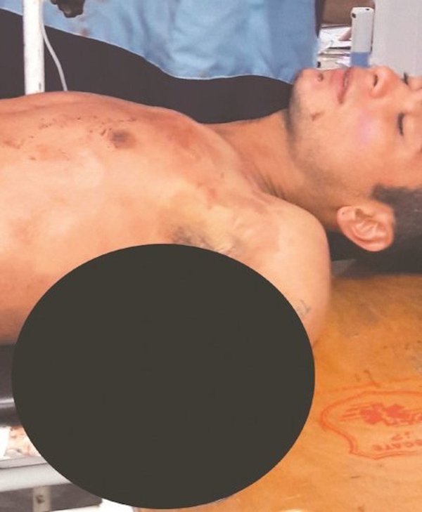 Joven pierde el brazo tras una macheteada en una fiesta | Noticias Paraguay