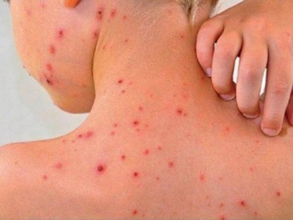 Ministerio está más preocupado por sarampión que por coronavirus | Noticias Paraguay