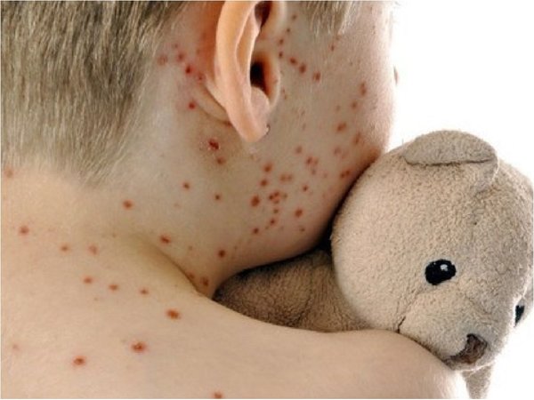Ingreso de sarampión preocupa más que el coronavirus, dice ministro de Salud