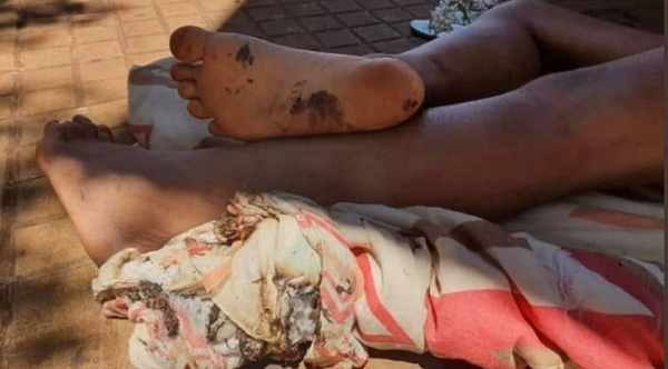 CDE: Hallan a mujer indigente con una ampolla en los pies tras quemadura » Ñanduti
