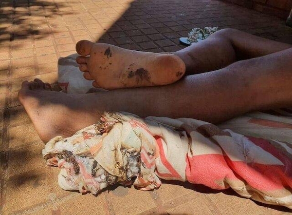 HOY / Denuncian que mujer indígena en Ciudad del Este presentaba rastros de quemaduras en los pies