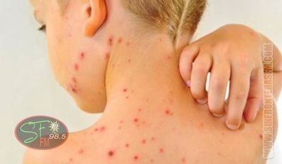 Ante riesgo de ingreso de sarampión instan a aplicarse la vacuna como protección