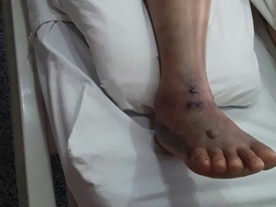 Víbora mordió a profe: piden ayuda