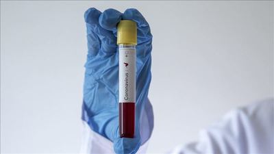 Aumento de pruebas por día evitaría mayor propagación del Coronavirus - Paraguay Informa